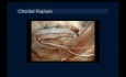 Réparation de Valve Mitrale
