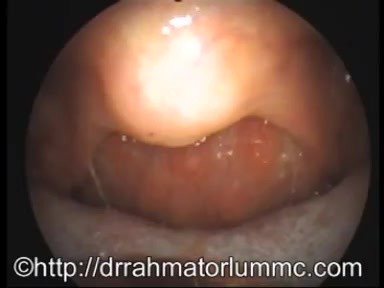 Hyperplasie de la paroi postérieure du pharynx