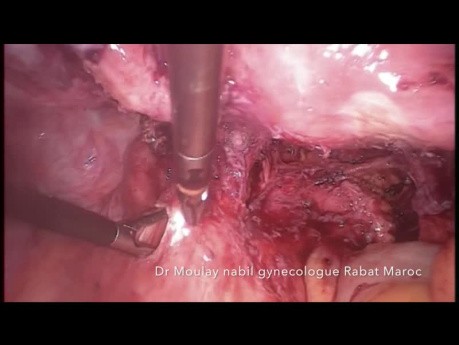 Laparoscopie pour Endométriose Recto-Vaginale Sévère