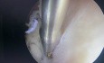 Polype Endométrial