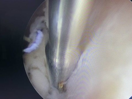 Polype Endométrial