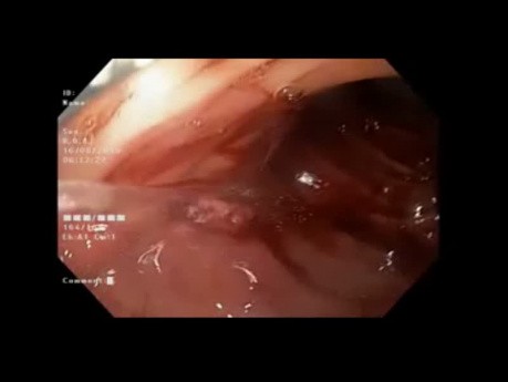 Hémorragie chez un patient porteur d'un "Mega Stent"