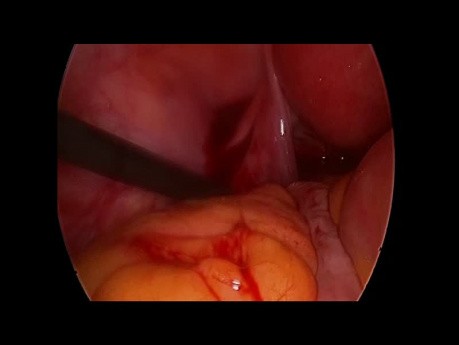 Grossesse extra-utérine - l'échographie laparoscopique