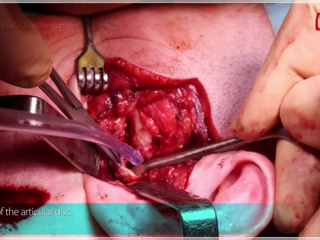 Remplacement Total Alloplastique de l'Articulation Temporo-Mandibulaire