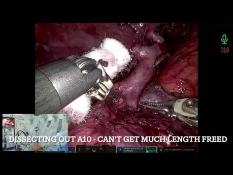 Chirurgie robotique pour séquestration intralobaire (segmentectomie gauche S6 + 10)