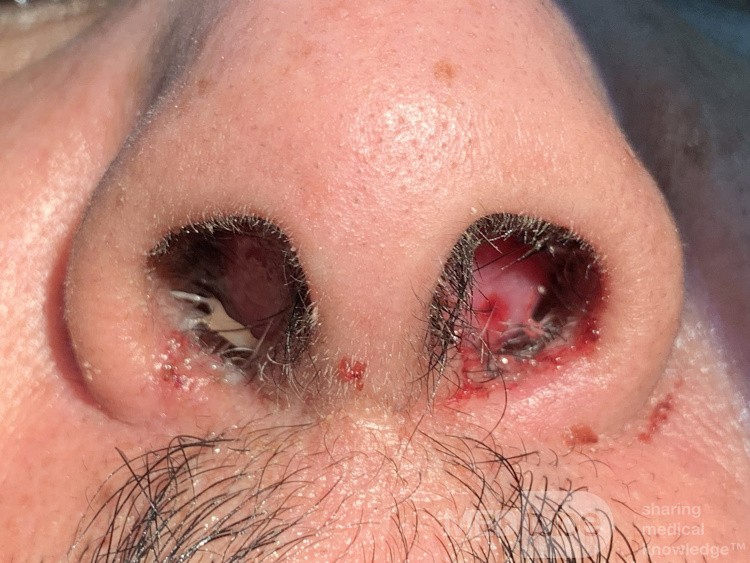Hématome Septal Post-Traumatique