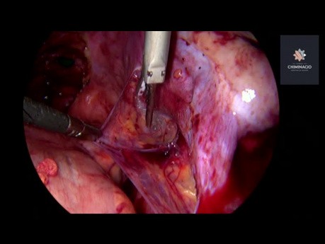 Chirurgie de l'endométriose profonde