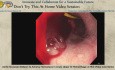 Ballon d'Occlusion Aortique pour l'Hémostase en Cas d'Hémorragie Digestive Haute Aiguë : Mini-Cas Vidéo