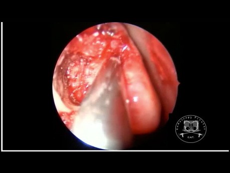 La dacryocystorhinostomie (DCR) endoscopique.