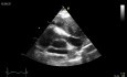 L'échocardiographie trans-oesophagienne, RVOT - la présence d'une masse médiastinale.