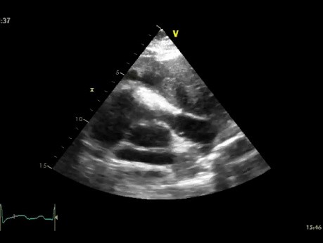 L'échocardiographie trans-oesophagienne, RVOT - la présence d'une masse médiastinale.