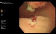 Polype Rectal Pédonculé