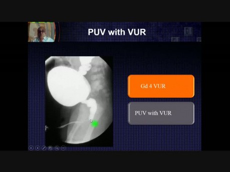  Le reflux vésico-urétéral (RVU)