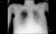 Radiographie thoracique d'un patient COVID-19 (1)