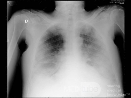 Radiographie thoracique d'un patient COVID-19 (1)