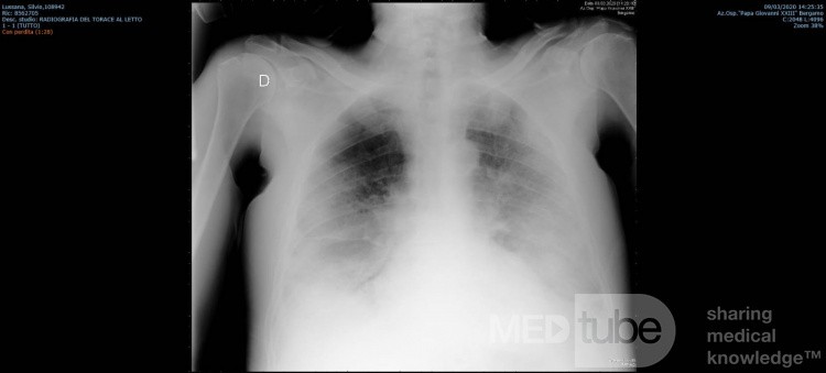 Radiographie thoracique d'un patient COVID-19 (1)