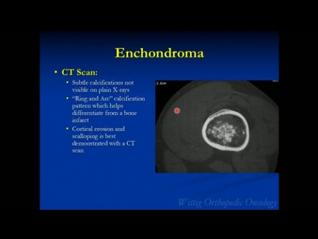 Cours d'oncologie orthopédique - Tumeurs bénignes du cartilage (ostéochondrome, chondroblastome, etc.) - Conférence 5