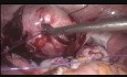 Myomectomie des plusieurs fibromes avec utilisation du fil de suture Vicryl