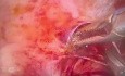 Résection d'un Nodule Endométriosique sur le Ligament Utéro-Sacré