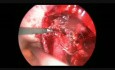 Hydronéphrose urétérale lié à l'endométriose - prise en charge laparoscopique
