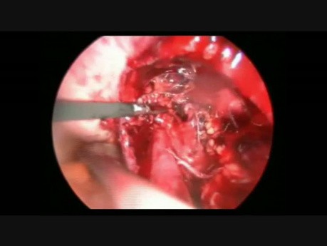 Hydronéphrose urétérale lié à l'endométriose - prise en charge laparoscopique