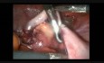 Appendicectomie laparoscopique en raison de l'endométriose