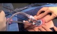 Chirurgie transanale mini-invasive - modification