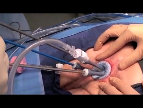 Chirurgie transanale mini-invasive - modification