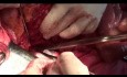La résection chirurgicale d'un tumeur rétropéritonéale avec néphrectomie gauche.