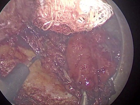 Résection Locale - Cancer du Rectum après Traitement Néoadjuvant et Réponse Incomplète