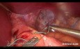 Fundoplicature Toupet