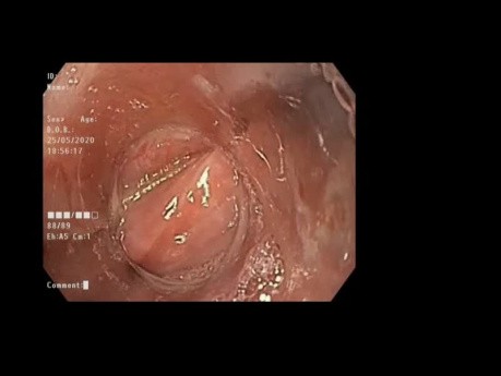 Extraction de corps etranger oesophagien .