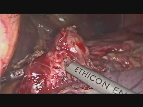Gastrectomie totale par laparoscopie avec esophagojéjunostomie en utilisant l'OrVil
