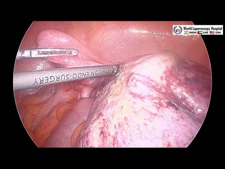 Oophorectomie laparoscopique pour la torsion ovarienne