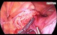 Hystérectomie totale par laparoscopie pour un utérus très volumineux avec un gros fibrome
