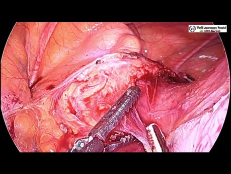 Hystérectomie totale par laparoscopie pour un utérus très volumineux avec un gros fibrome