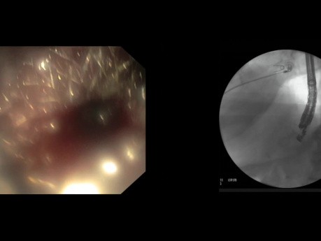 Gastrostomie pancréatique