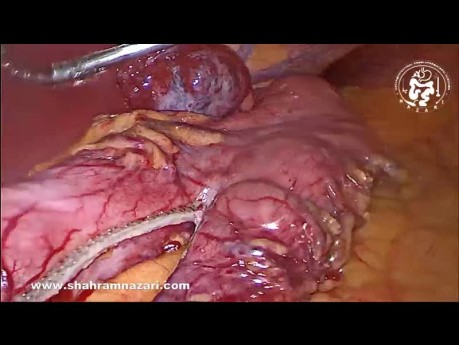 Large Hémangiome du Foie (Incidentalome) dans un Cas de Gastrectomie Sleeve