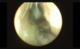 Myringotomie endoscopique et insertion d'œillets sous anesthésie locale
