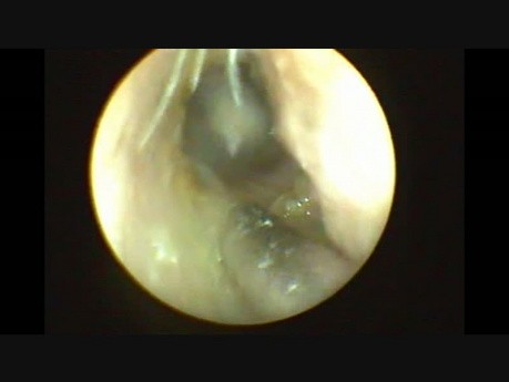 Myringotomie endoscopique et insertion d'œillets sous anesthésie locale