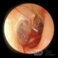 Glomus tympanique de l'oreille moyenne droite