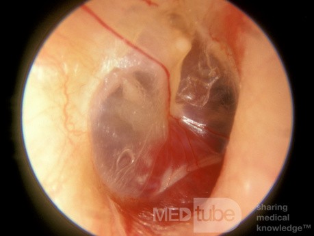 Glomus tympanique de l'oreille moyenne droite