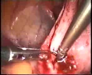 Prise en charge d'une endométriose profonde par voie laparoscopique