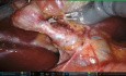 Cholécystectomie Robotisée Cholangio-ICG et CPO supra-pubiens et Bikini