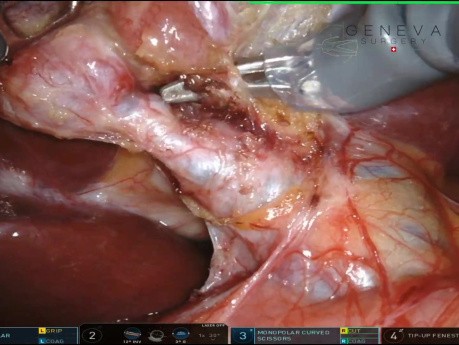 Cholécystectomie Robotisée Cholangio-ICG et CPO supra-pubiens et Bikini