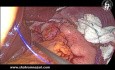 Fundoplication de Nissen Laparoscopique