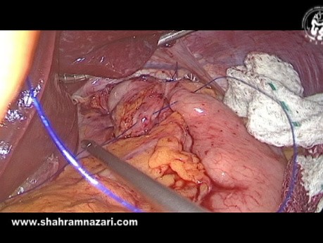 Fundoplication de Nissen Laparoscopique