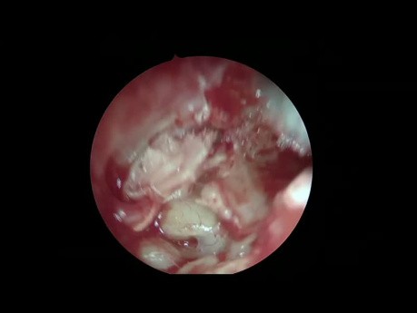 Cholestéatome - Approche Endoscopique Combinée : Transcanalaire + Transmastoïdienne