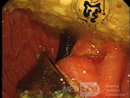 Érosion de l'anneau gastrique - vue endoscopique