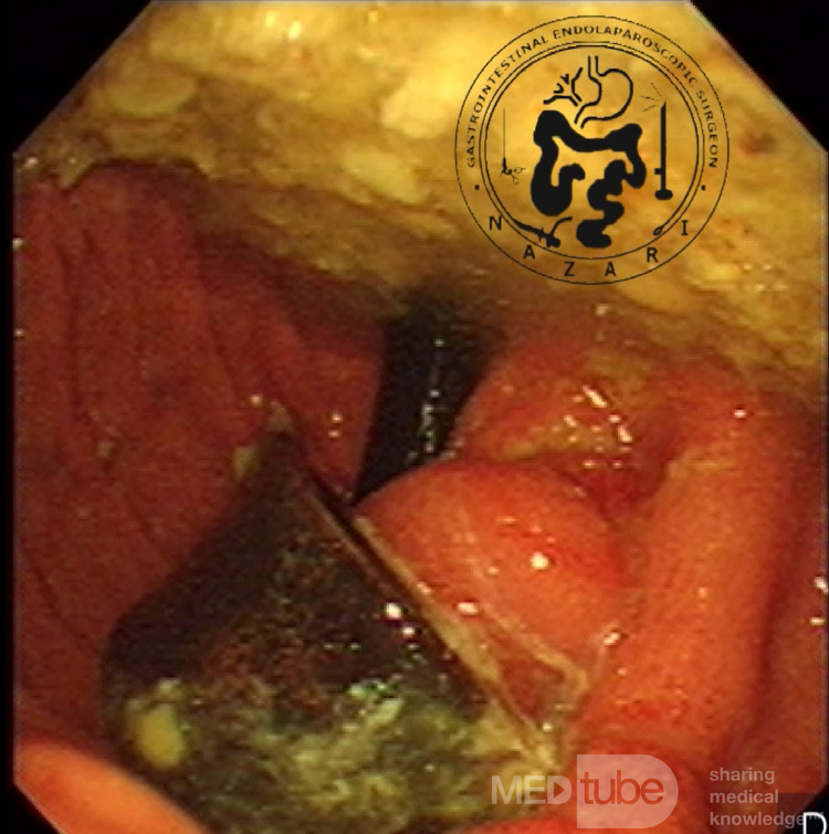 Érosion de l'anneau gastrique - vue endoscopique